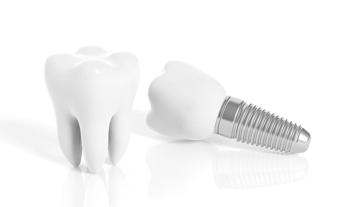 implantologia-dentaval-dentistas-valencia